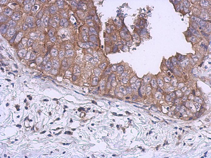 IHC of paraffin-embedded Breast ca using UKHC antibody at 1:500 dilution.
