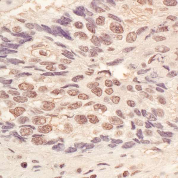 Detection of Human L3MBTL3 by Immunohistochemistry. Sample: FFPE section of human lung carcinoma. Antibody: Affinity purified rabbit anti-L3MBTL3 used at a dilution of 1:1000 (1 ug/ml). Detection: Vector Laboratories ImmPACT NovaRED Peroxidase Substrate.