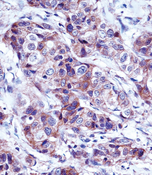 LALBA Antibody immunohistochemistry of formalin-fixed and paraffin-embedded human breast carcinoma followed by peroxidase-conjugated secondary antibody and DAB staining.