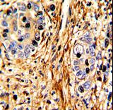 Formalin-fixed and paraffin-embedded human hepatocarcinoma with LAMB2 Antibody , which was peroxidase-conjugated to the secondary antibody, followed by DAB staining. This data demonstrates the use of this antibody for immunohistochemistry; clinical relevance has not been evaluated.