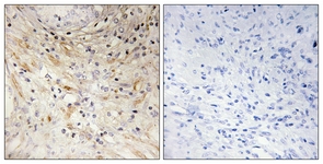 IHC of paraffin-embedded human prostate carcinoma tissue, using LAMB3 Antibody. The picture on the right is treated with the synthesized peptide.