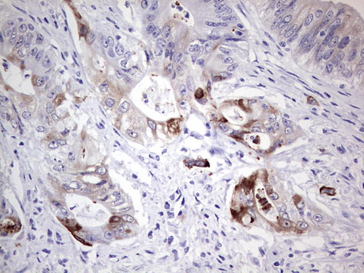 IHC of paraffin-embedded Adenocarcinoma of Human colon tissue using anti-LAMB3 mouse monoclonal antibody. (Heat-induced epitope retrieval by 1 mM EDTA in 10mM Tris, pH8.5, 120°C for 3min).