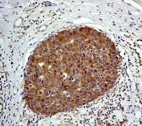 IHC of paraffin-embedded human breast carcinoma using anti-MP1 (C-term) antibody.