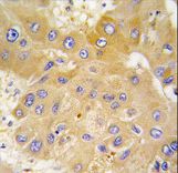 Formalin-fixed and paraffin-embedded human hepatocarcinoma tissue reacted with LAP3 antibody , which was peroxidase-conjugated to the secondary antibody, followed by DAB staining. This data demonstrates the use of this antibody for immunohistochemistry; clinical relevance has not been evaluated.