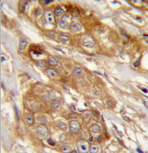 GRINA Antibody immunohistochemistry of formalin-fixed and paraffin-embedded human breast carcinoma followed by peroxidase-conjugated secondary antibody and DAB staining.