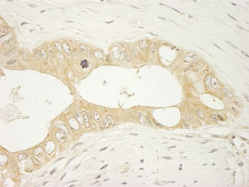 Detection of Human LARP1 by Immunohistochemistry. Sample: FFPE section of human colon carcinoma. Antibody: Affinity purified rabbit anti-LARP used at a dilution of 1:250.