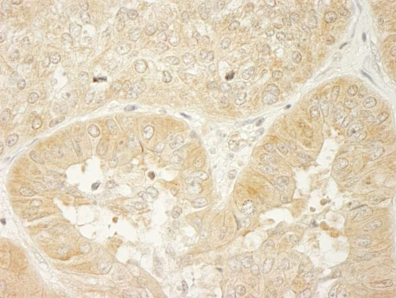 Detection of Human LARP1 by Immunohistochemistry. Sample: FFPE section of human ovarian carcinoma. Antibody: Affinity purified rabbit anti-LARP1 used at a dilution of 1:200 (1 Detection: DAB.