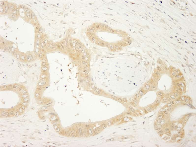 Detection of Human LARP1 by Immunohistochemistry. Sample: FFPE section of human colon carcinoma. Antibody: Affinity purified rabbit anti-LARP1 used at a dilution of 1:200 (1 Detection: DAB.