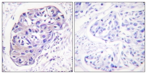 IHC of paraffin-embedded human breast carcinoma tissue, using GRK2 (Ab-29) Antibody. The picture on the right is treated with the synthesized peptide.