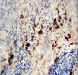 LCE1A antibody immunohistochemistry of formalin-fixed and paraffin-embedded human skin carcinoma followed by peroxidase-conjugated secondary antibody and DAB staining.