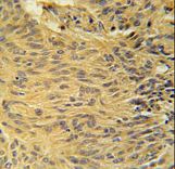 LCLT1 Antibody immunohistochemistry of formalin-fixed and paraffin-embedded human lung carcinoma followed by peroxidase-conjugated secondary antibody and DAB staining.