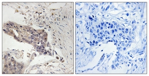 IHC of paraffin-embedded human breast carcinoma tissue, using SLP-76 (Ab-128) Antibody. The picture on the right is treated with the synthesized peptide.