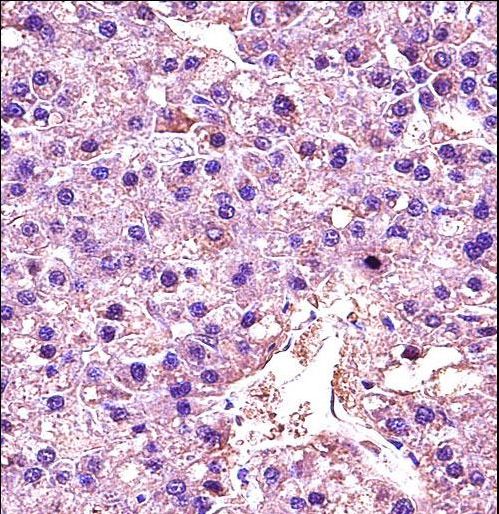 LDHA Antibody immunohistochemistry of formalin-fixed and paraffin-embedded human hepatocarcinoma followed by peroxidase-conjugated secondary antibody and DAB staining.