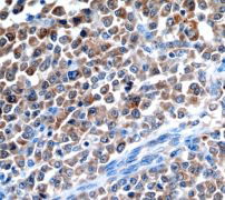 IHC of paraffin-embedded human testis carcinoma using anti-LDH-C antibody.