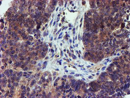 IHC of paraffin-embedded Adenocarcinoma of Human ovary tissue using anti-LECT2 mouse monoclonal antibody.