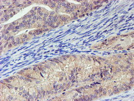 IHC of paraffin-embedded Adenocarcinoma of Human endometrium tissue using anti-LECT2 mouse monoclonal antibody.