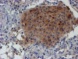 IHC of paraffin-embedded Carcinoma of Human lung tissue using anti-LECT2 mouse monoclonal antibody.