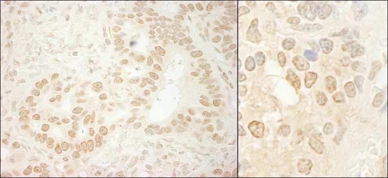 Detection of Human and Mouse LEO1 by Immunohistochemistry. Sample: FFPE section of human stomach carcinoma (left) and mouse teratoma (right). Antibody: Affinity purified rabbit anti-LEO1 used at a dilution of 1:5000 (0.2and 1:1000 (1 Detection: DAB.