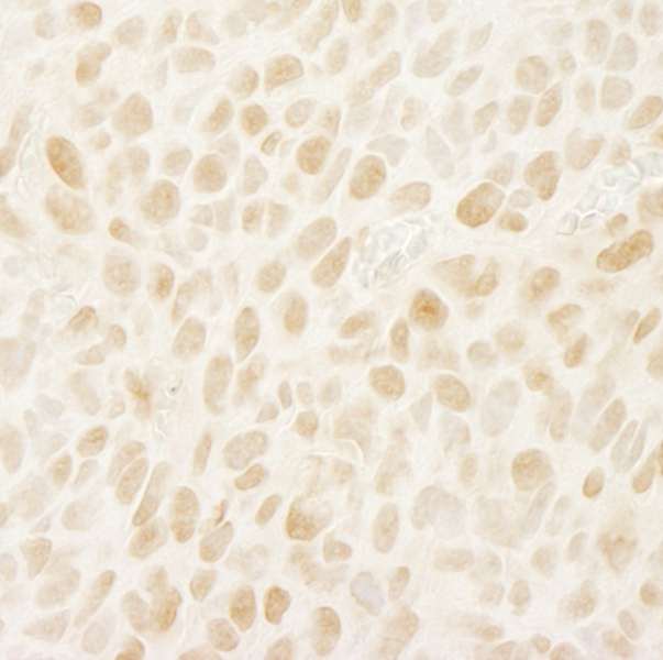 Detection of Mouse Leo1 by Immunohistochemistry. Sample: FFPE section of mouse colon carcinoma CT26. Antibody: Affinity purified rabbit anti-Leo1 used at a dilution of 1:100. Epitope Retrieval Buffer-High pH (IHC-101J) was substituted for Epitope Retrieval Buffer-Reduced pH.