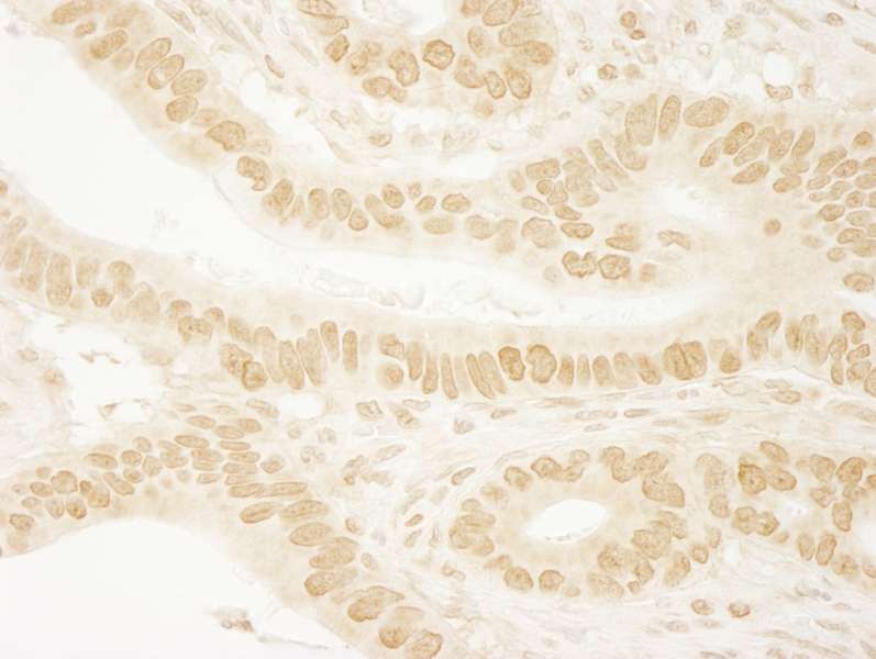 Detection of Human Leo1 by Immunohistochemistry. Sample: FFPE section of human stomach adenocarcinoma. Antibody: Affinity purified rabbit anti-Leo1 used at a dilution of 1:100. Epitope Retrieval Buffer-High pH (IHC-101J) was substituted for Epitope Retrieval Buffer-Reduced pH.