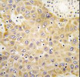 Formalin-fixed and paraffin-embedded human hepatocarcinoma tissue reacted with GRK5 Antibody , which was peroxidase-conjugated to the secondary antibody, followed by DAB staining. This data demonstrates the use of this antibody for immunohistochemistry; clinical relevance has not been evaluated.