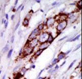 Formalin-fixed and paraffin-embedded human cancer tissue reacted with the primary antibody, which was peroxidase-conjugated to the secondary antibody, followed by DAB staining. This data demonstrates the use of this antibody for immunohistochemistry; clinical relevance has not been evaluated. BC = breast carcinoma; HC = hepatocarcinoma.