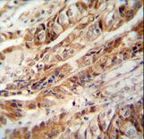 ZC3H15 antibody immunohistochemistry of formalin-fixed and paraffin-embedded human colon carcinoma followed by peroxidase-conjugated secondary antibody and DAB staining.
