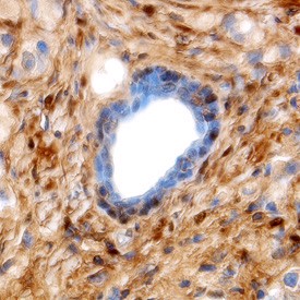 Galectin-1 in Human Prostate Cancer Tissue. Galectin-1 was detected in immersion fixed paraffin-embedded sections of human prostate cancer tissue using 1.7 ug/ml Goat Anti-Human Galectin-1 Antigen Affinity-purified Polyclonal Antibody overnight at 4°C. Tissue was stained with Anti-Goat HRP-DAB (brown) and counterstained with hematoxylin (blue).