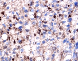 Galectin-1 in Human Prostate Cancer Tissue. Galectin-1 was detected in immersion fixed paraffin-embedded sections of human prostate cancer tissue using Goat Anti-Human Galectin-1 Antigen Affinity-purified Polyclonal Antibody at 5 ug/ml overnight at 4°C. Tissue was stained using Anti-Goat HRP-DAB (brown) and counterstained with hematoxylin (blue). Specific labeling was localized to the cytoplasm of stromal cells and nuclei of epithelial cells.