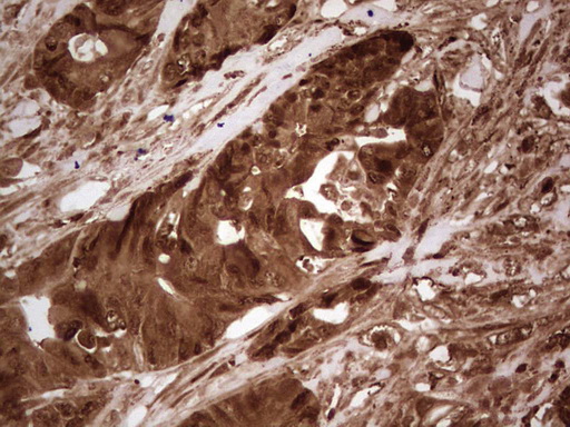 IHC of paraffin-embedded Adenocarcinoma of Human colon tissue using anti-LGALS9 mouse monoclonal antibody. (Heat-induced epitope retrieval by 1 mM EDTA in 10mM Tris, pH8.5, 120°C for 3min).