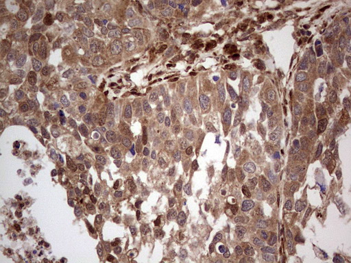 IHC of paraffin-embedded Carcinoma of Human kidney tissue using anti-LGALS9 mouse monoclonal antibody. (Heat-induced epitope retrieval by 1 mM EDTA in 10mM Tris, pH8.5, 120°C for 3min).