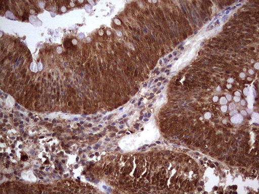 IHC of paraffin-embedded Adenocarcinoma of Human colon tissue using anti-LGALS9 mouse monoclonal antibody. (Heat-induced epitope retrieval by 1 mM EDTA in 10mM Tris, pH8.5, 120°C for 3min).