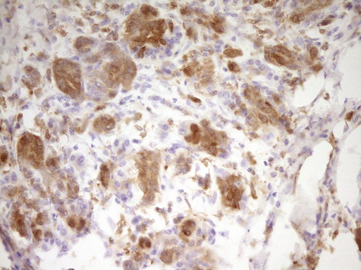 IHC of paraffin-embedded Carcinoma of Human pancreas tissue using anti-LGALS9 mouse monoclonal antibody. (Heat-induced epitope retrieval by 1 mM EDTA in 10mM Tris, pH8.5, 120°C for 3min).