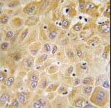 Formalin-fixed and paraffin-embedded human hepatocarcinoma tissue reacted with GRK7 Antibody , which was peroxidase-conjugated to the secondary antibody, followed by DAB staining. This data demonstrates the use of this antibody for immunohistochemistry; clinical relevance has not been evaluated.
