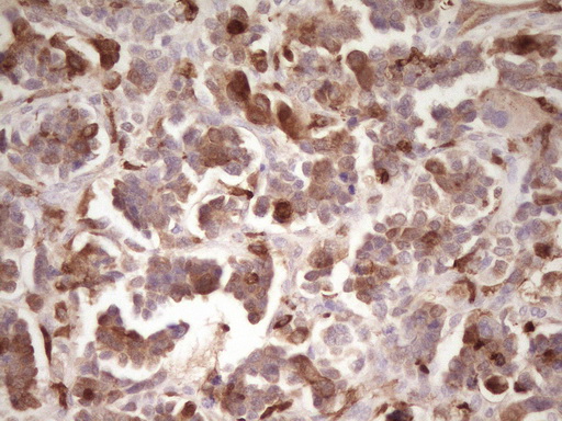 IHC of paraffin-embedded Adenocarcinoma of Human ovary tissue using anti-LGALS9 mouse monoclonal antibody. (Heat-induced epitope retrieval by 1 mM EDTA in 10mM Tris, pH8.5, 120°C for 3min).