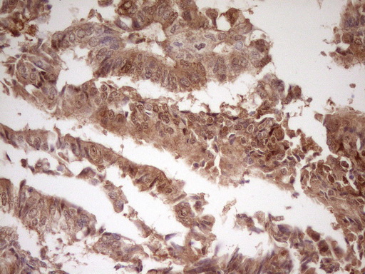 IHC of paraffin-embedded Adenocarcinoma of Human colon tissue using anti-LGALS9 mouse monoclonal antibody. (Heat-induced epitope retrieval by 1 mM EDTA in 10mM Tris, pH8.5, 120°C for 3min).