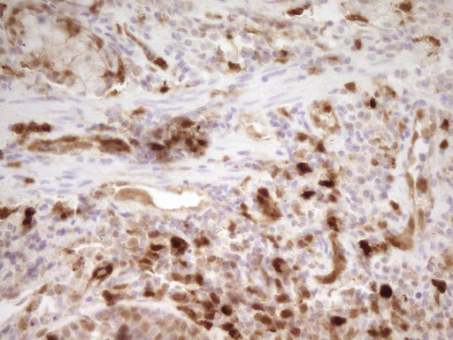 IHC of paraffin-embedded Carcinoma of Human lung tissue using anti-LGALS9 mouse monoclonal antibody. (Heat-induced epitope retrieval by 1 mM EDTA in 10mM Tris, pH8.5, 120°C for 3min).