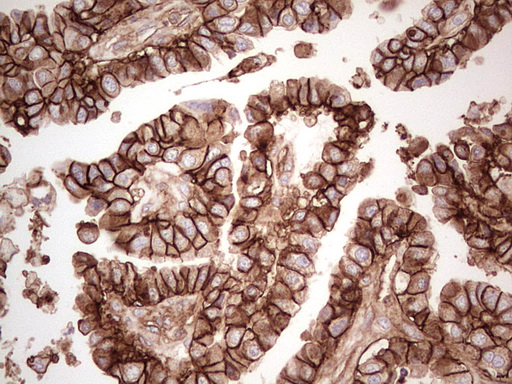 IHC of paraffin-embedded Adenocarcinoma of Human ovary tissue using anti-LGALS9 mouse monoclonal antibody. (Heat-induced epitope retrieval by 1 mM EDTA in 10mM Tris, pH8.5, 120°C for 3min).