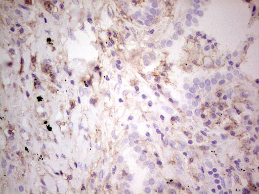 IHC of paraffin-embedded Carcinoma of Human lung tissue using anti-LGALS9 mouse monoclonal antibody. (Heat-induced epitope retrieval by 1 mM EDTA in 10mM Tris, pH8.5, 120°C for 3min).