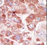 Formalin-fixed and paraffin-embedded human cancer tissue reacted with the primary antibody, which was peroxidase-conjugated to the secondary antibody, followed by AEC staining. This data demonstrates the use of this antibody for immunohistochemistry; clinical relevance has not been evaluated. BC = breast carcinoma; HC = hepatocarcinoma.