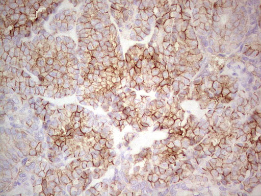 IHC of paraffin-embedded Carcinoma of Human thyroid tissue using anti-LGALS9 mouse monoclonal antibody. (Heat-induced epitope retrieval by 1 mM EDTA in 10mM Tris, pH8.5, 120°C for 3min).