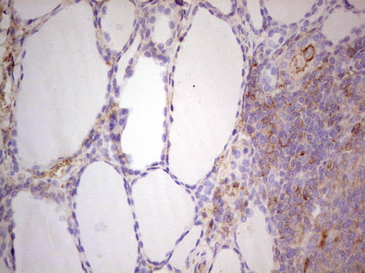 IHC of paraffin-embedded Human thyroid tissue using anti-LGALS9 mouse monoclonal antibody. (Heat-induced epitope retrieval by 1 mM EDTA in 10mM Tris, pH8.5, 120°C for 3min).