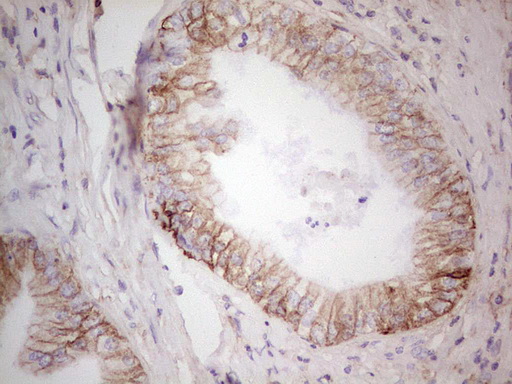 IHC of paraffin-embedded Carcinoma of Human pancreas tissue using anti-LGALS9 mouse monoclonal antibody. (Heat-induced epitope retrieval by 1 mM EDTA in 10mM Tris, pH8.5, 120°C for 3min).
