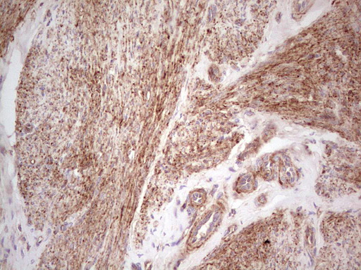 IHC of paraffin-embedded Adenocarcinoma of Human endometrium tissue using anti-LGALS9 mouse monoclonal antibody. (Heat-induced epitope retrieval by 1 mM EDTA in 10mM Tris, pH8.5, 120°C for 3min).