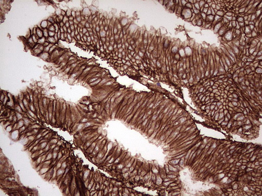 IHC of paraffin-embedded Adenocarcinoma of Human colon tissue using anti-LGALS9 mouse monoclonal antibody. (Heat-induced epitope retrieval by 1 mM EDTA in 10mM Tris, pH8.5, 120°C for 3min).