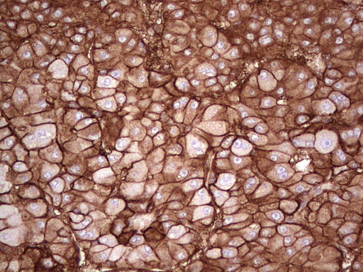 IHC of paraffin-embedded Carcinoma of Human liver tissue using anti-LGALS9 mouse monoclonal antibody. (Heat-induced epitope retrieval by 1 mM EDTA in 10mM Tris, pH8.5, 120°C for 3min).