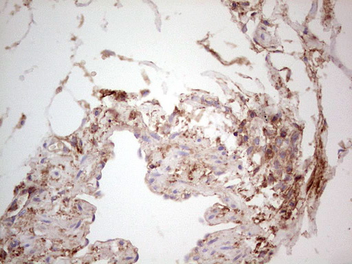 IHC of paraffin-embedded Carcinoma of Human kidney tissue using anti-LGALS9 mouse monoclonal antibody. (Heat-induced epitope retrieval by 1 mM EDTA in 10mM Tris, pH8.5, 120°C for 3min).