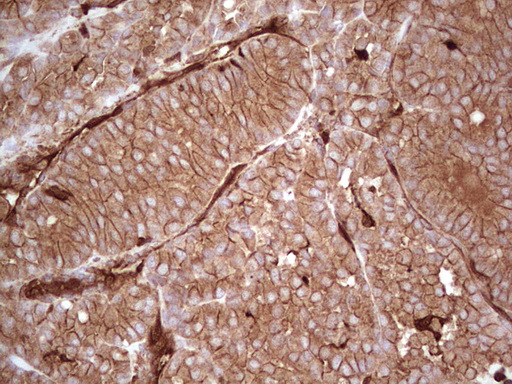 IHC of paraffin-embedded Carcinoma of Human thyroid tissue using anti-LGALS9 mouse monoclonal antibody. (Heat-induced epitope retrieval by 1 mM EDTA in 10mM Tris, pH8.5, 120°C for 3min).
