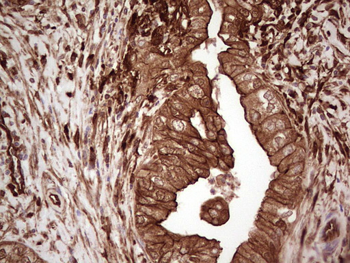 IHC of paraffin-embedded Carcinoma of Human pancreas tissue using anti-LGALS9 mouse monoclonal antibody. (Heat-induced epitope retrieval by 1 mM EDTA in 10mM Tris, pH8.5, 120°C for 3min).
