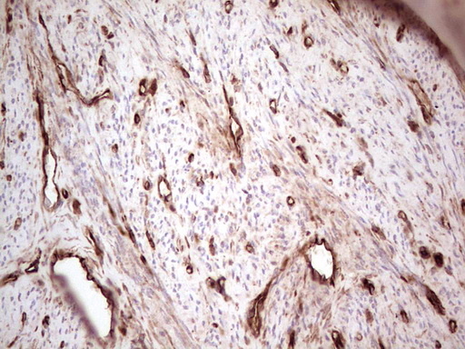 IHC of paraffin-embedded Adenocarcinoma of Human endometrium tissue using anti-LGALS9 mouse monoclonal antibody. (Heat-induced epitope retrieval by 1 mM EDTA in 10mM Tris, pH8.5, 120°C for 3min).